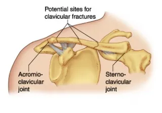 Fracture physiopedia
