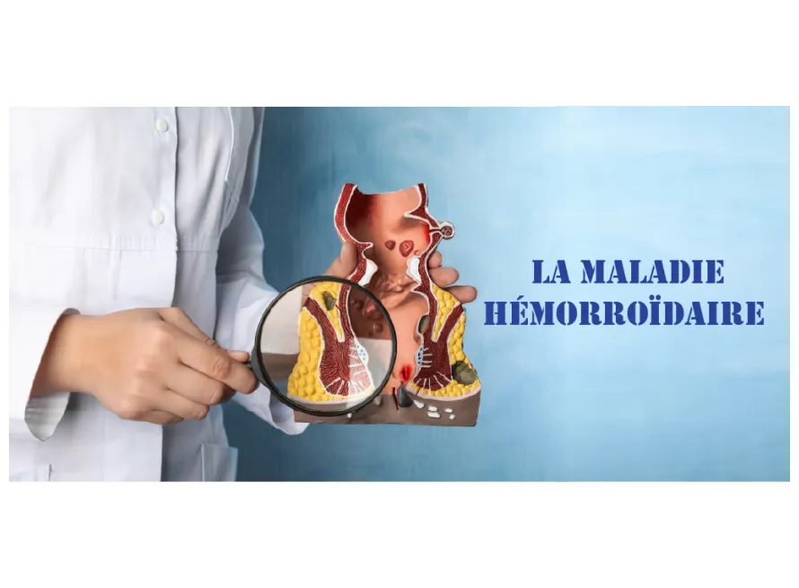 La maladie hémorroïdaire blog a.legrand