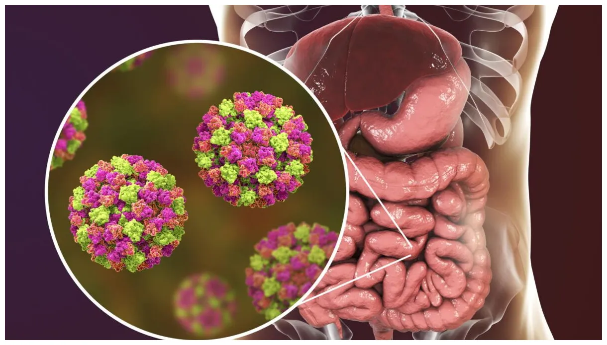 Norovirus nach covid-19 eine neue epidemie mit pest-symptomen