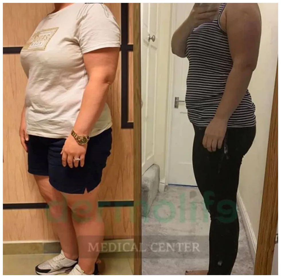 Baloni gastrik proçedura jokirurgjikale për dobesim