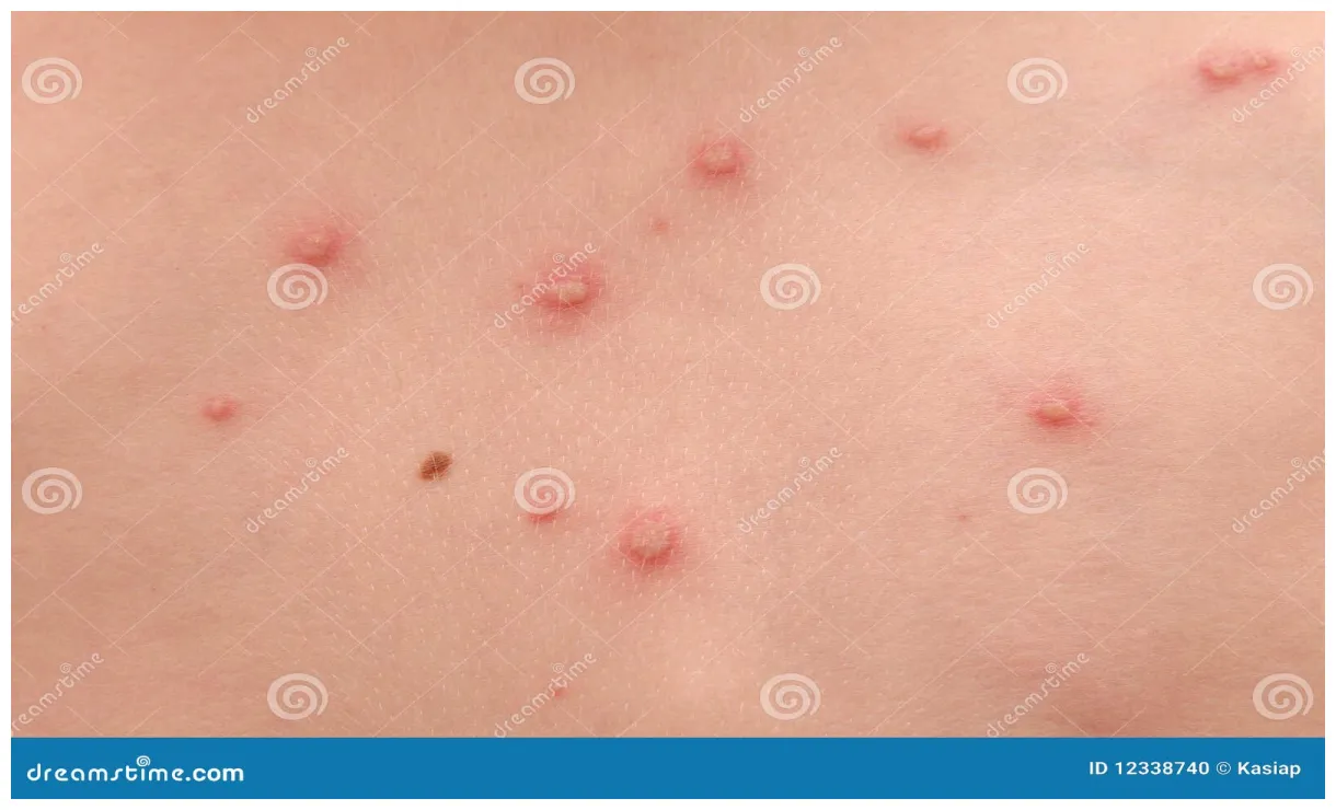 Stock foto. of vlekken, reactie, pediatrisch 12338740