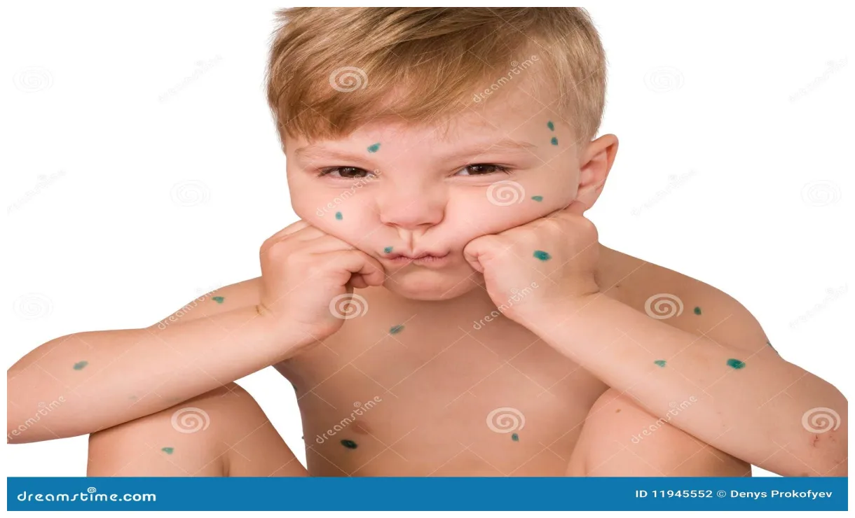 Stock foto. of mazelen, menselijk, lichaam 11945552