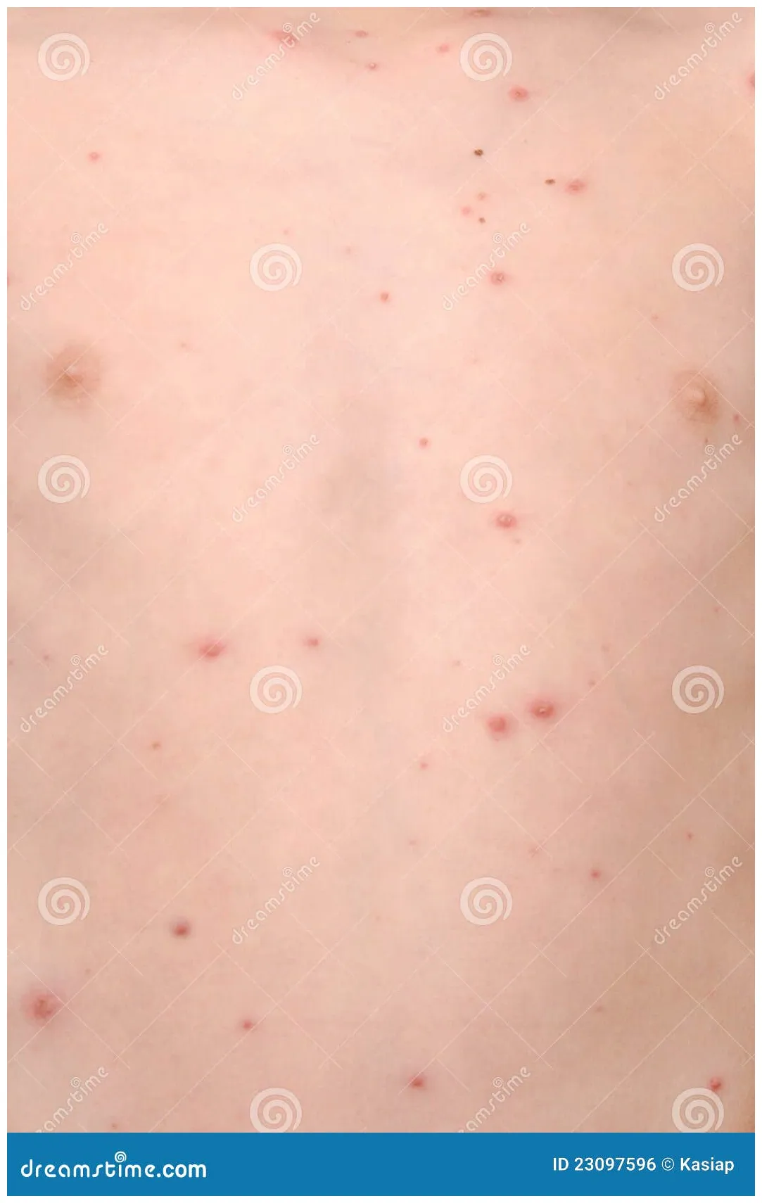 Stock foto. of vlekken, symptomen, ziek 23097596