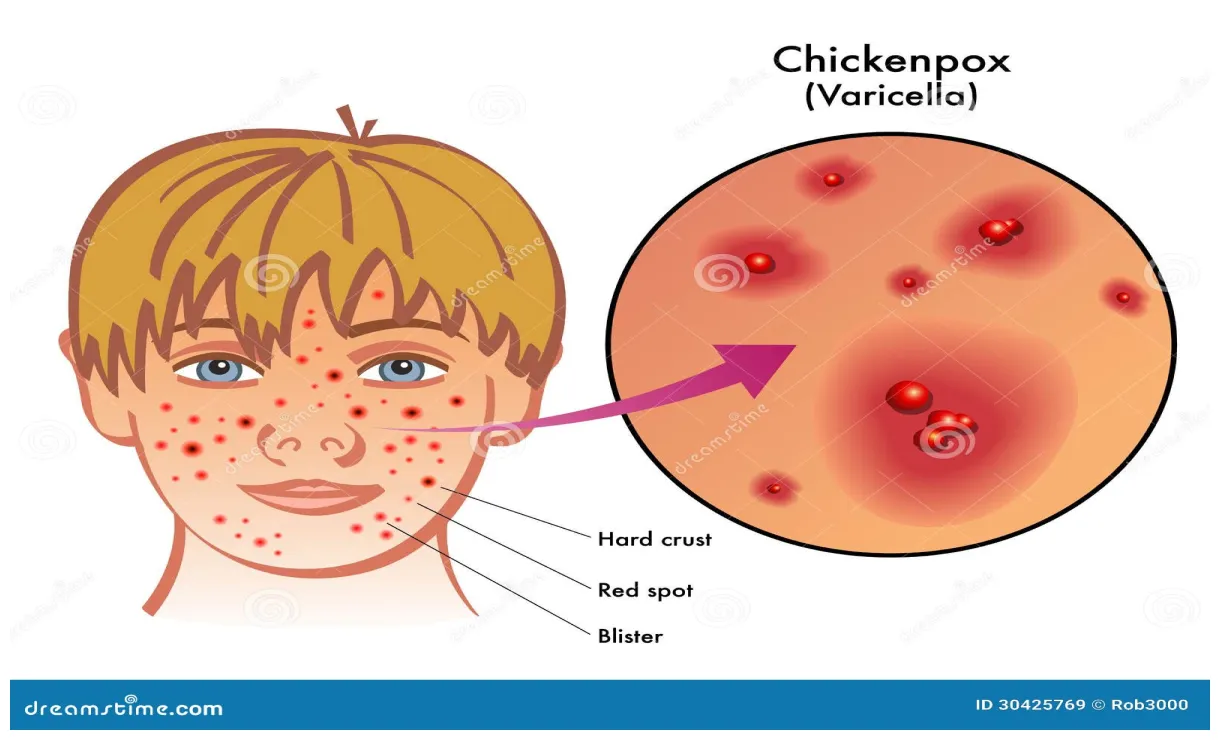 Vector illustratie. illustration of immuun 30425769